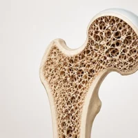 Destacada-osteoporosis-profesionales-355x266px