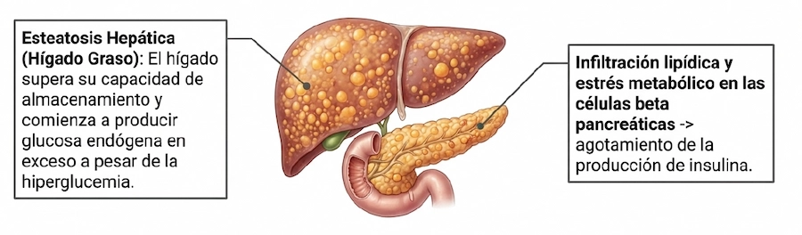 Ilustración de hígado graso e infiltración lipídica en células beta pancreáticas.
